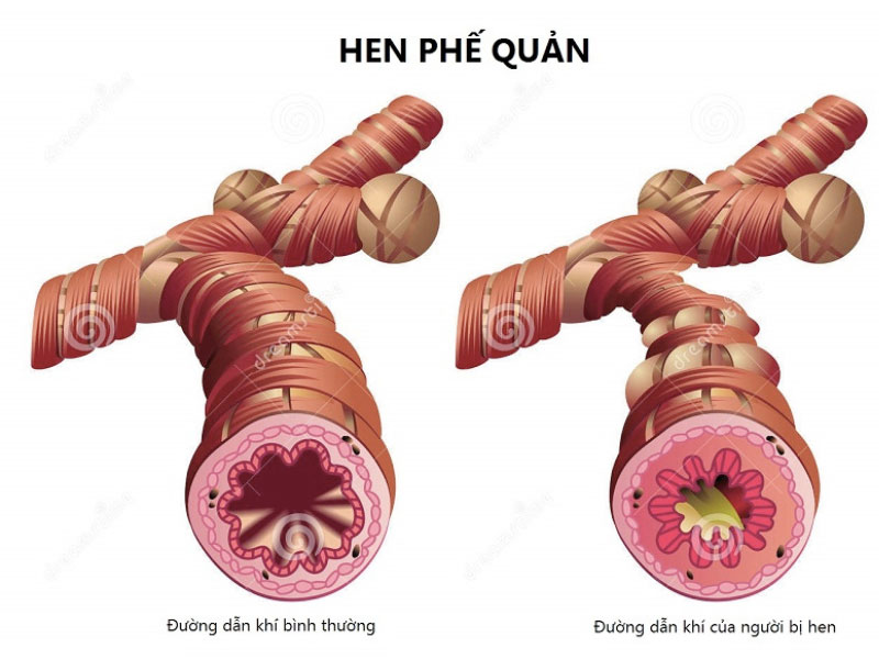 Biến chứng nếu không kiểm soát tốt