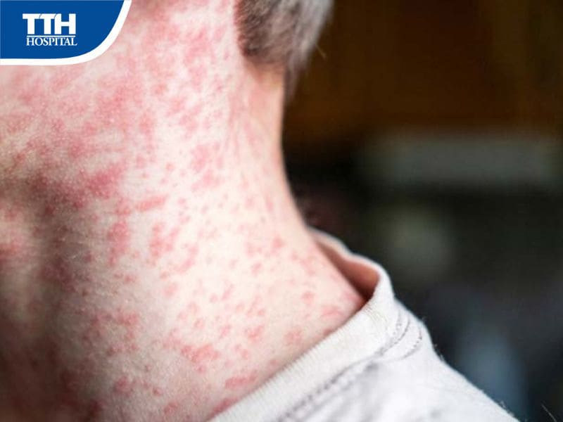 Dấu hiệu nhận biết bệnh sởi