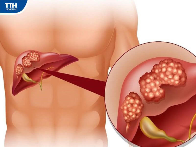 Các nguyên nhân gây bệnh