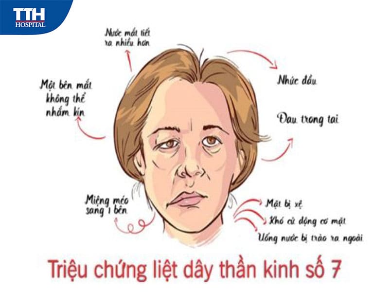 Cách điều trị liệt dây thần kinh số 7 