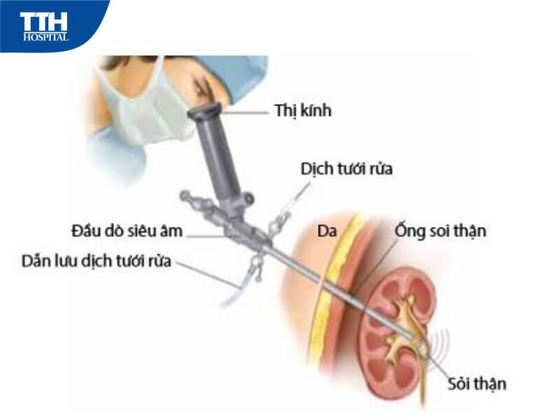 Chăm sóc và phòng ngừa sỏi thận tái phát
