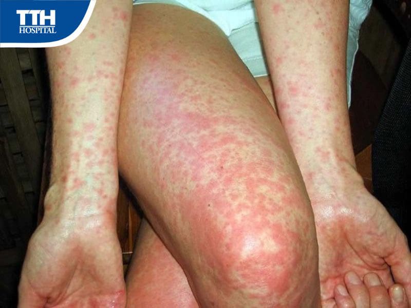 Các biến chứng của bệnh sởi