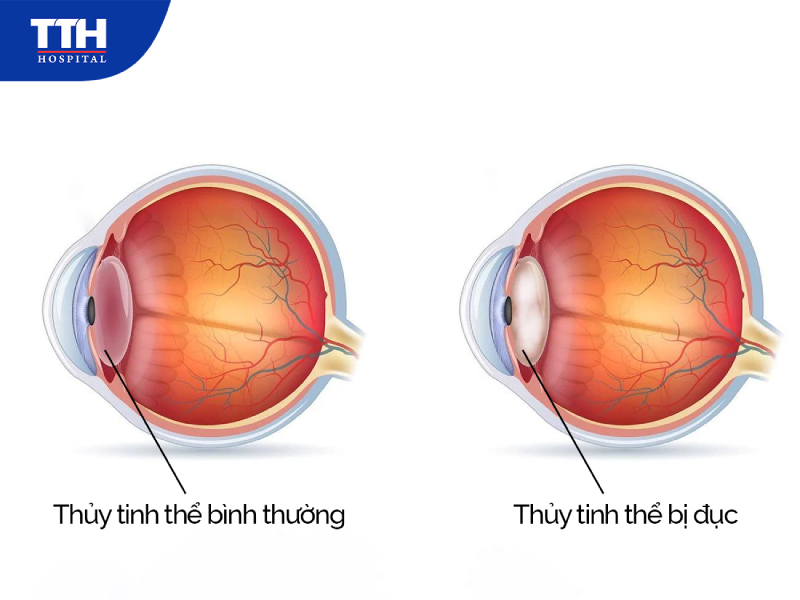 Đục thủy tinh thể là gì?
