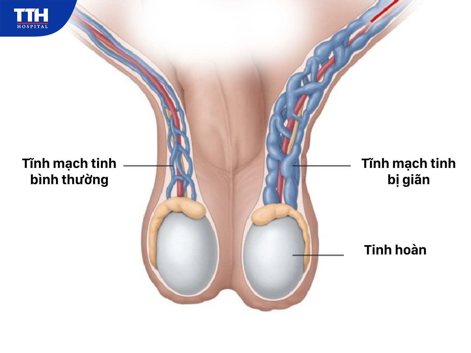 Giãn tĩnh mạch thừng tinh là gì?