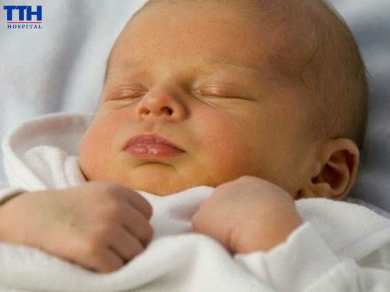 Hiểu đúng về vàng da sơ sinh