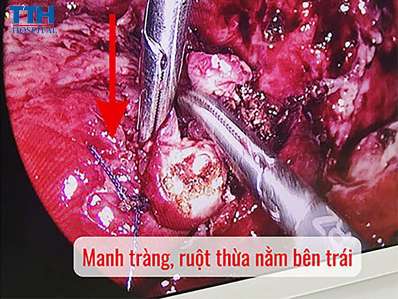 Phát hiện sớm, xử trí kịp thời – Giữ trọn sự sống cho người bệnh lớn tuổi