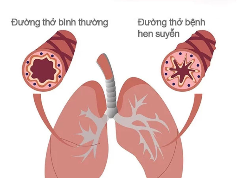 Kiểm soát hen phế quản lâu dài như thế nào?