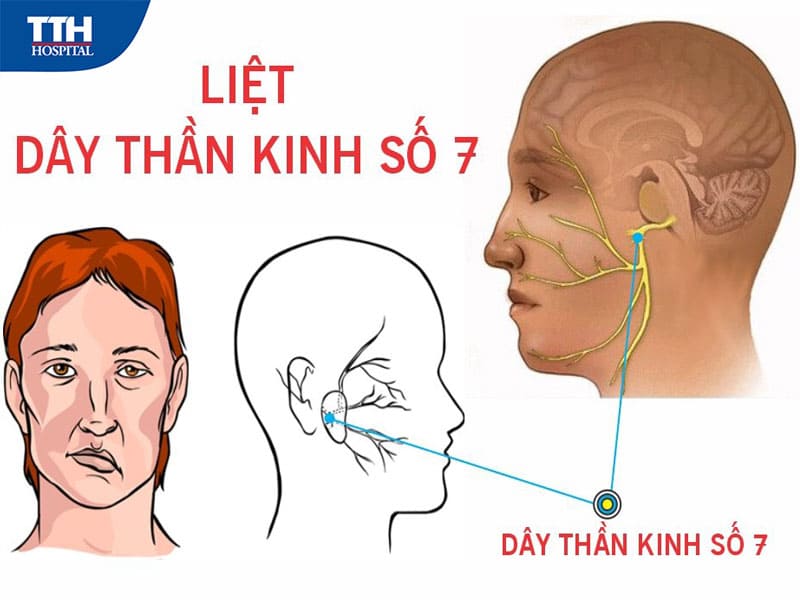 Liệt dây thần kinh số 7 có nguy hiểm không?