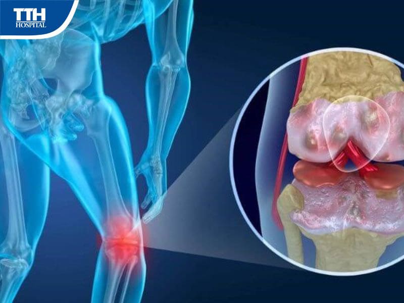 Nguyên nhân dẫn đến tràn dịch khớp gối