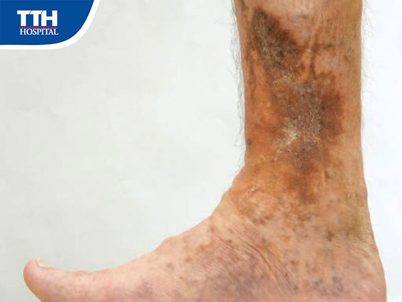 Những biến chứng nguy hại khi không điều trị suy tĩnh mạch chi dưới kịp thời