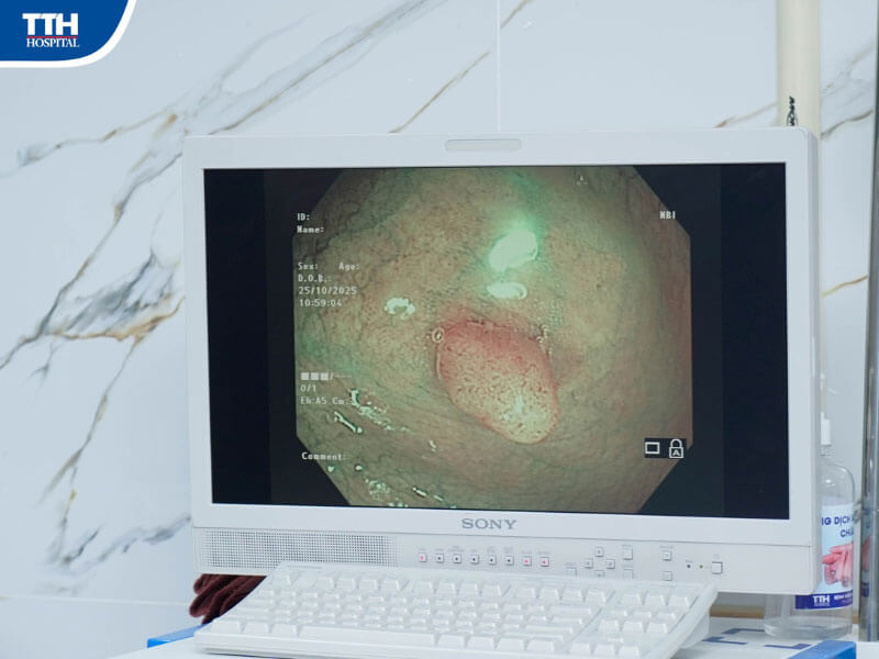 Nội soi tiêu hóa tại Bệnh viện Đa khoa TTH Quảng Bình