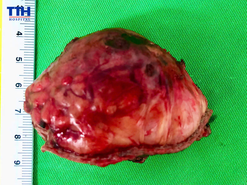 Phẫu thuật nội soi - Phương pháp điều trị ít xâm lấn, hiệu quả lâu dài