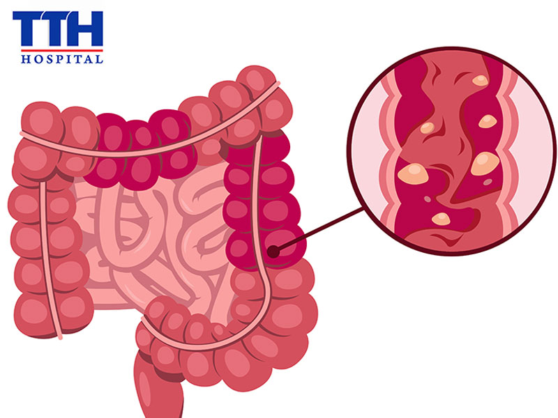 Polyp tiêu hóa là gì?