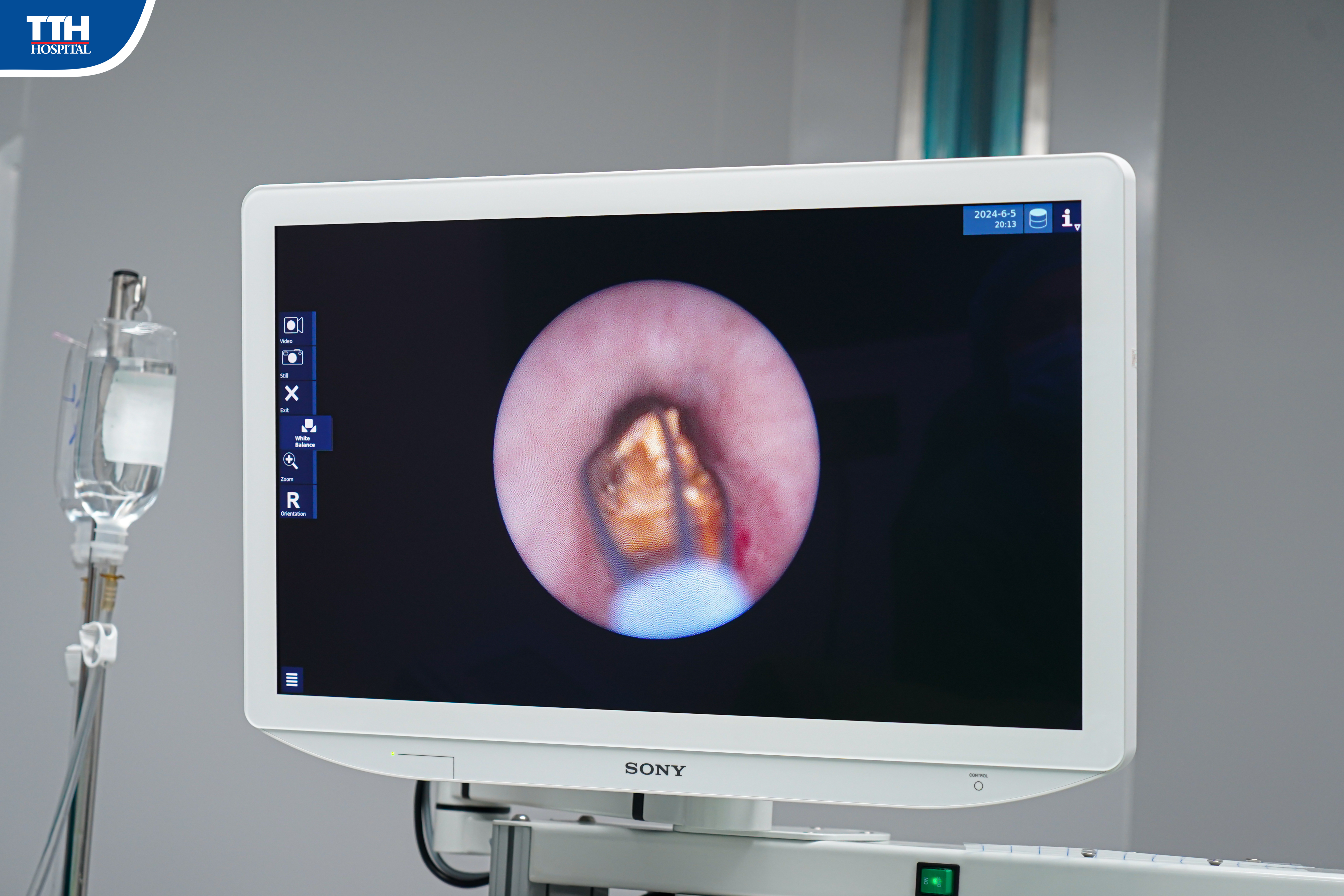 Tán sỏi ống soi mềm