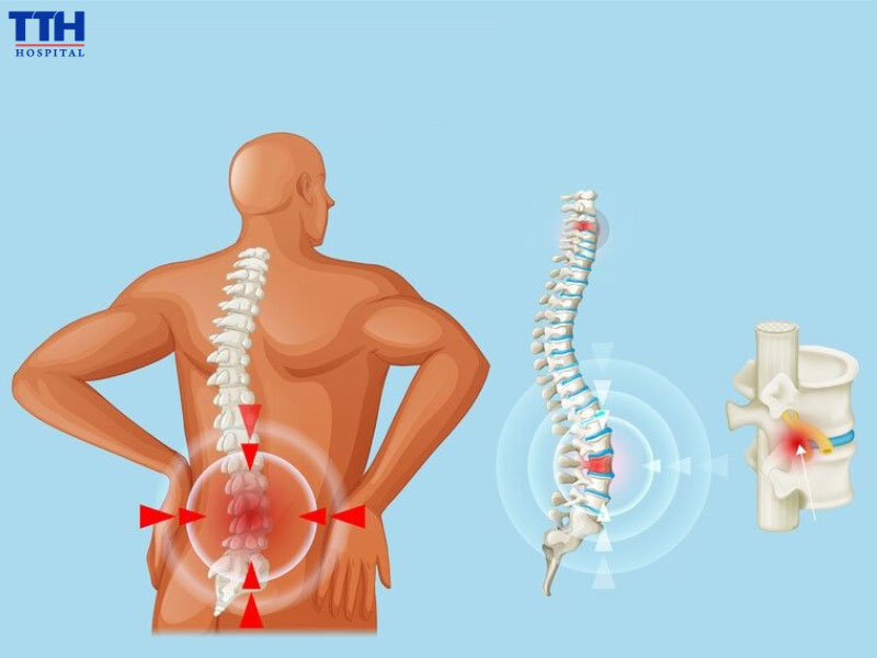 Thoát vị đĩa đệm là gì?