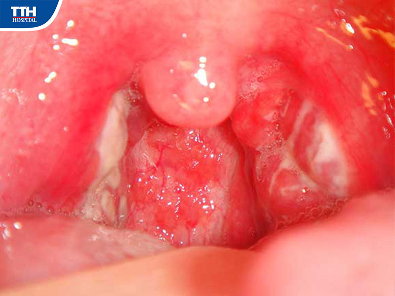 Vì sao viêm amidan mãn tính dễ tái phát?