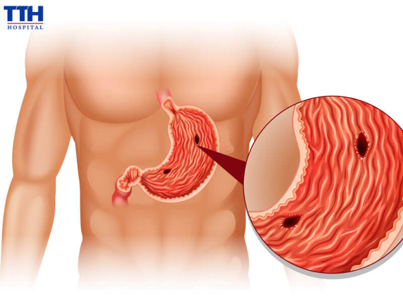 Viêm loét dạ dày – tá tràng là gì?