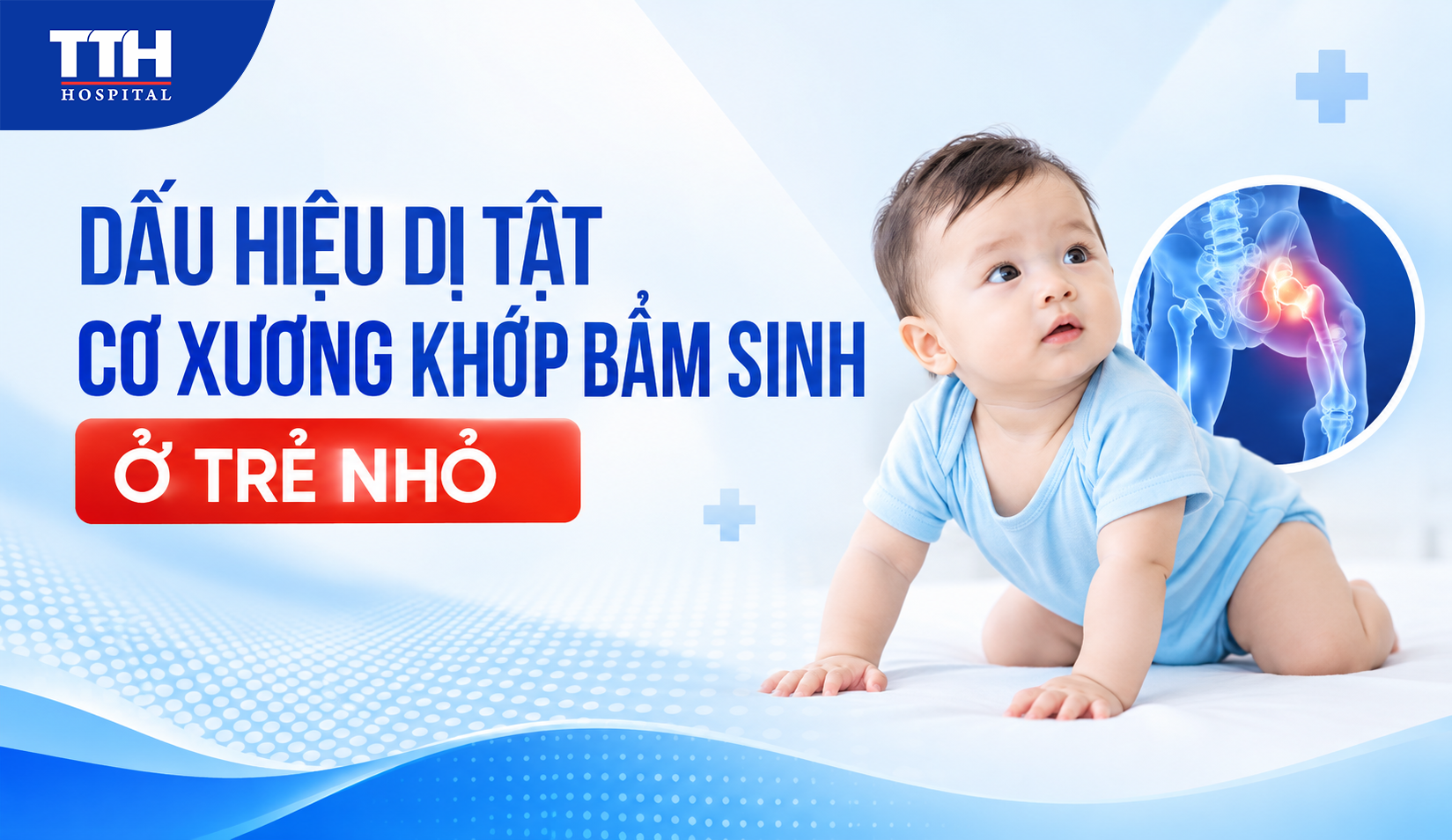 DẤU HIỆU DỊ TẬT CƠ XƯƠNG KHỚP BẨM SINH Ở TRẺ NHỎ