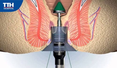 Phẫu thuật trĩ Longo: Ưu, nhược điểm và quy trình chăm sóc sau khi phẫu thuật