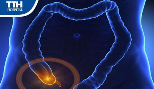 Viêm ruột thừa: Nguyên nhân gây bệnh, dấu hiệu nhận biết và cách phòng ngừa hiệu quả nhất