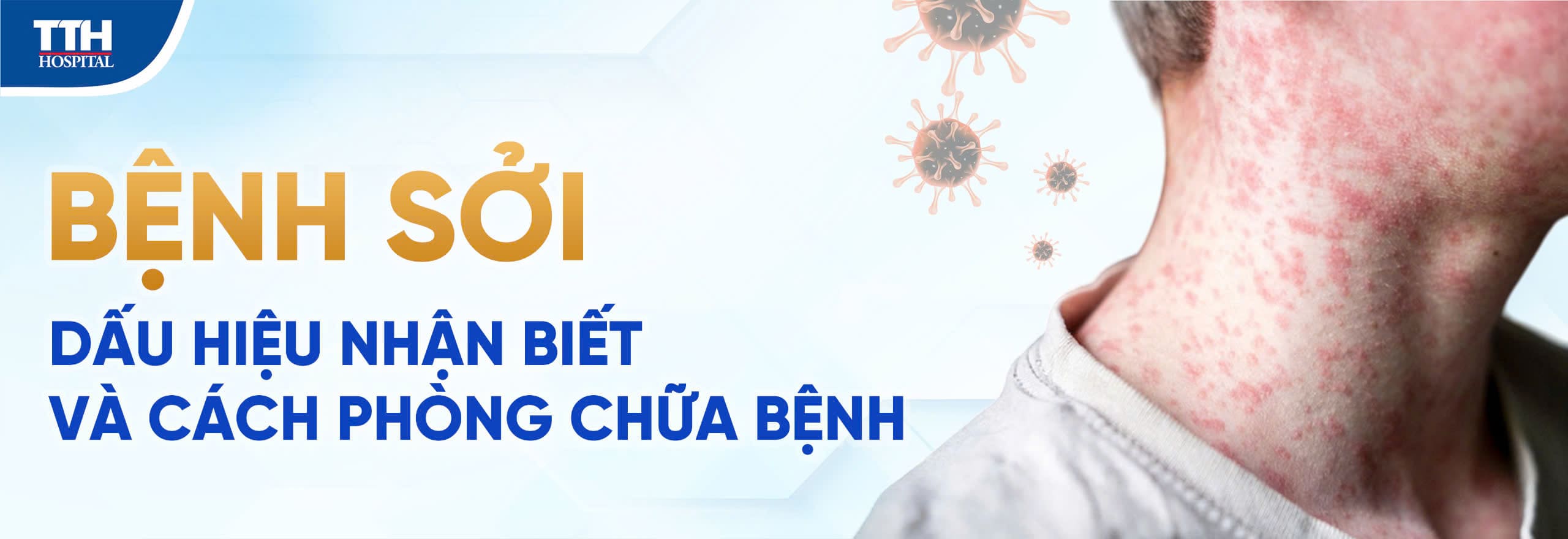 Bệnh sởi: Dấu hiệu nhận biết và cách phòng chữa bệnh