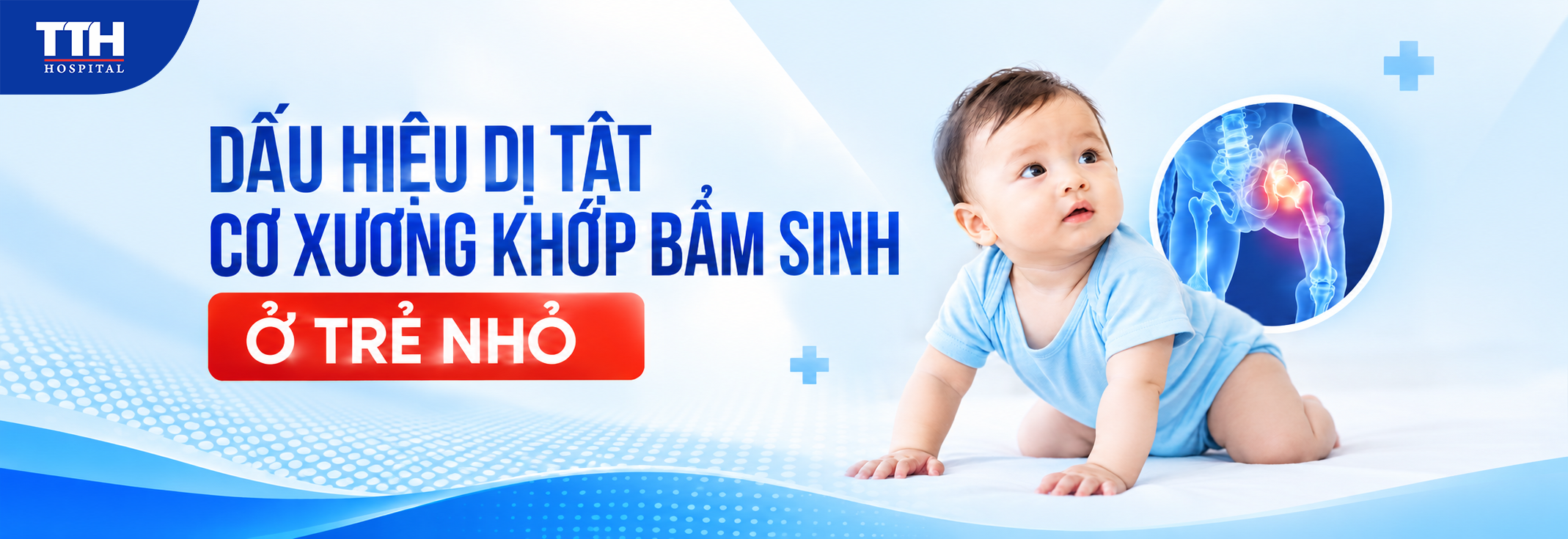 DẤU HIỆU DỊ TẬT CƠ XƯƠNG KHỚP BẨM SINH Ở TRẺ NHỎ