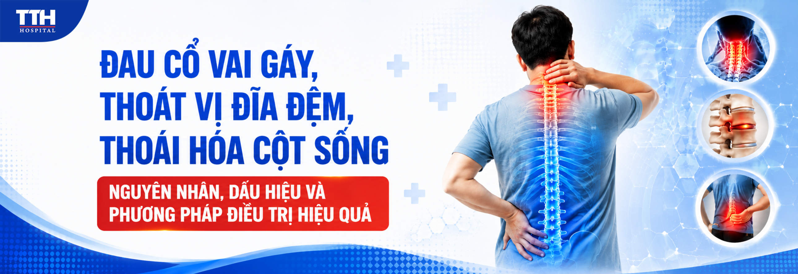 ĐAU CỔ VAI GÁY, THOÁT VỊ ĐĨA ĐỆM, THOÁI HÓA CỘT SỐNG: NGUYÊN NHÂN, DẤU HIỆU VÀ PHƯƠNG PHÁP ĐIỀU TRỊ HIỆU QUẢ