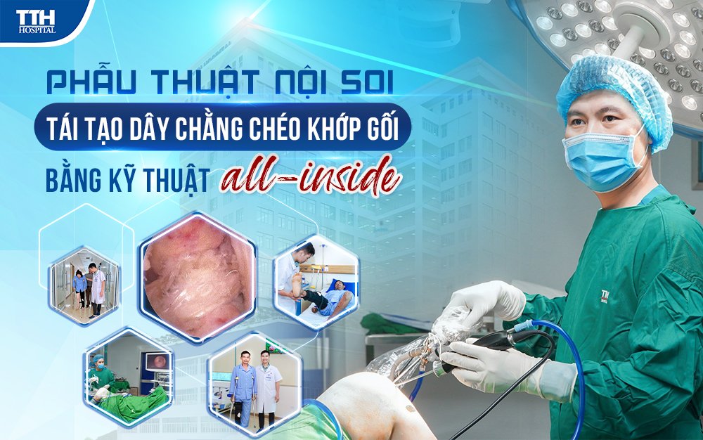 Phẫu thuật nội soi tái tạo dây chằng chéo khớp gối bằng kỹ thuật all-inside