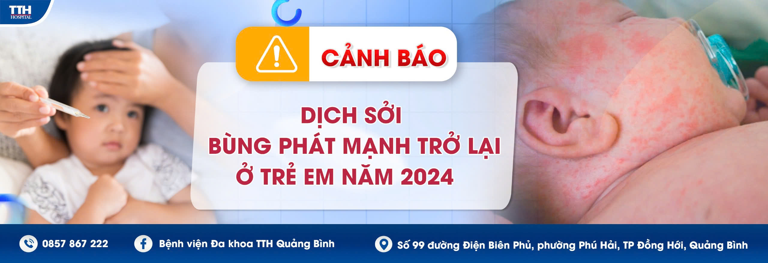 Dịch sởi 2024: Mối nguy hiểm đối với trẻ em và tầm quan trọng của việc thăm khám kịp thời