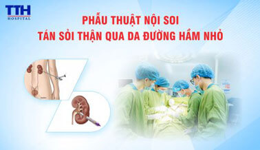 PHẪU THUẬT NỘI SOI TÁN SỎI THẬN QUA DA ĐƯỜNG HẦM NHỎ