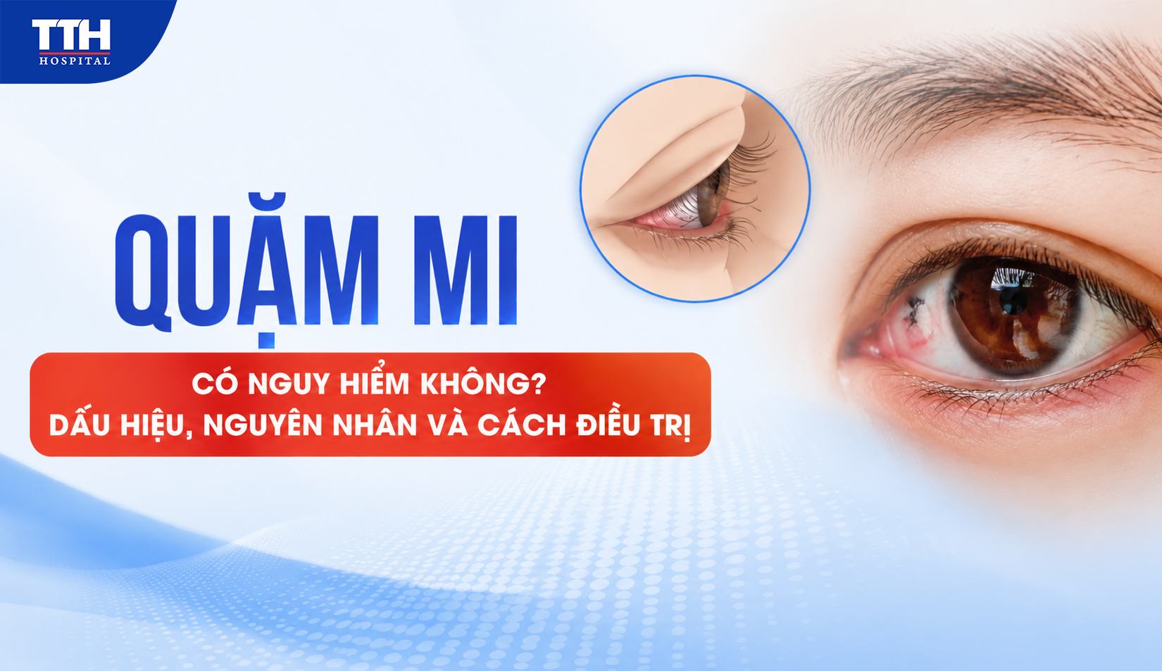 QUẶM MI CÓ NGUY HIỂM KHÔNG? DẤU HIỆU, NGUYÊN NHÂN VÀ CÁCH ĐIỀU TRỊ
