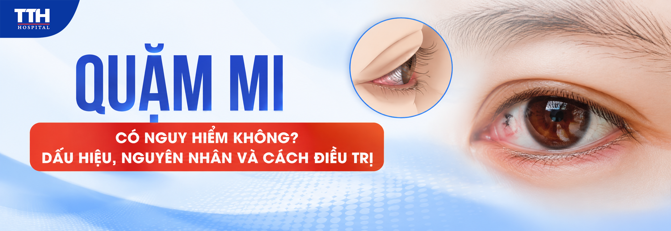 QUẶM MI CÓ NGUY HIỂM KHÔNG? DẤU HIỆU, NGUYÊN NHÂN VÀ CÁCH ĐIỀU TRỊ