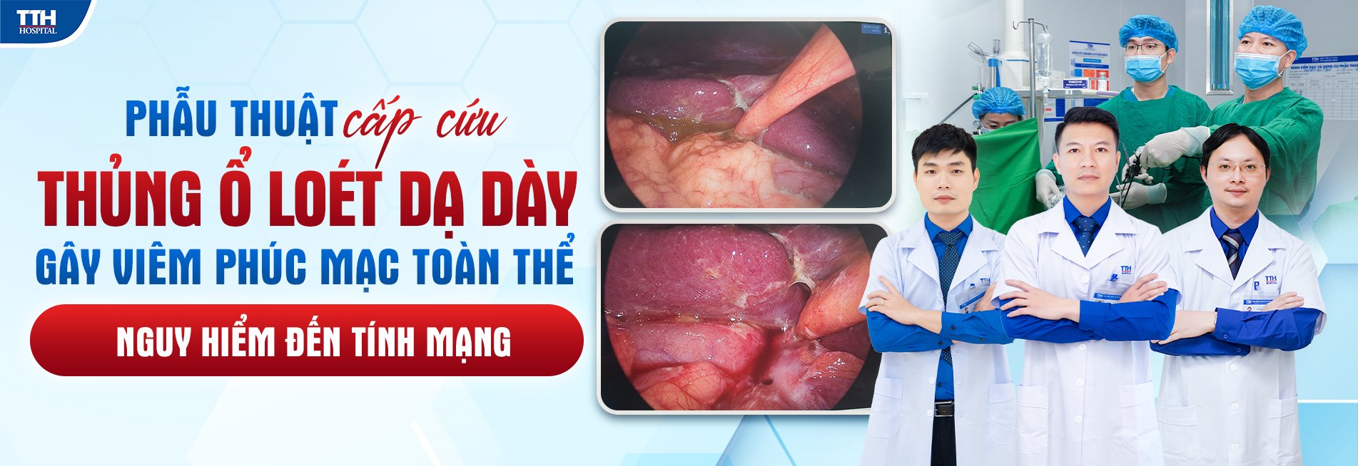 Phẫu thuật cấp cứu thủng ổ loét dạ dày gây viêm phúc mạc toàn thể nguy hiểm đến tính mạng