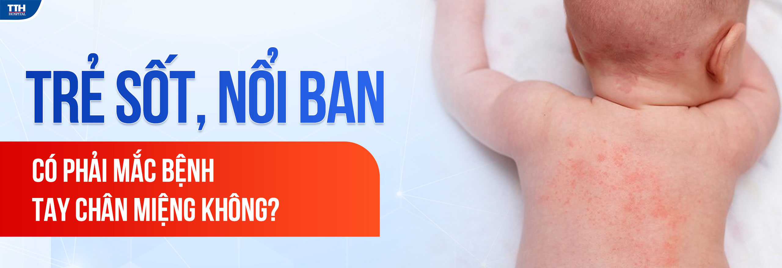 TRẺ SỐT, NỔI BAN - CÓ PHẢI TAY CHÂN MIỆNG KHÔNG?