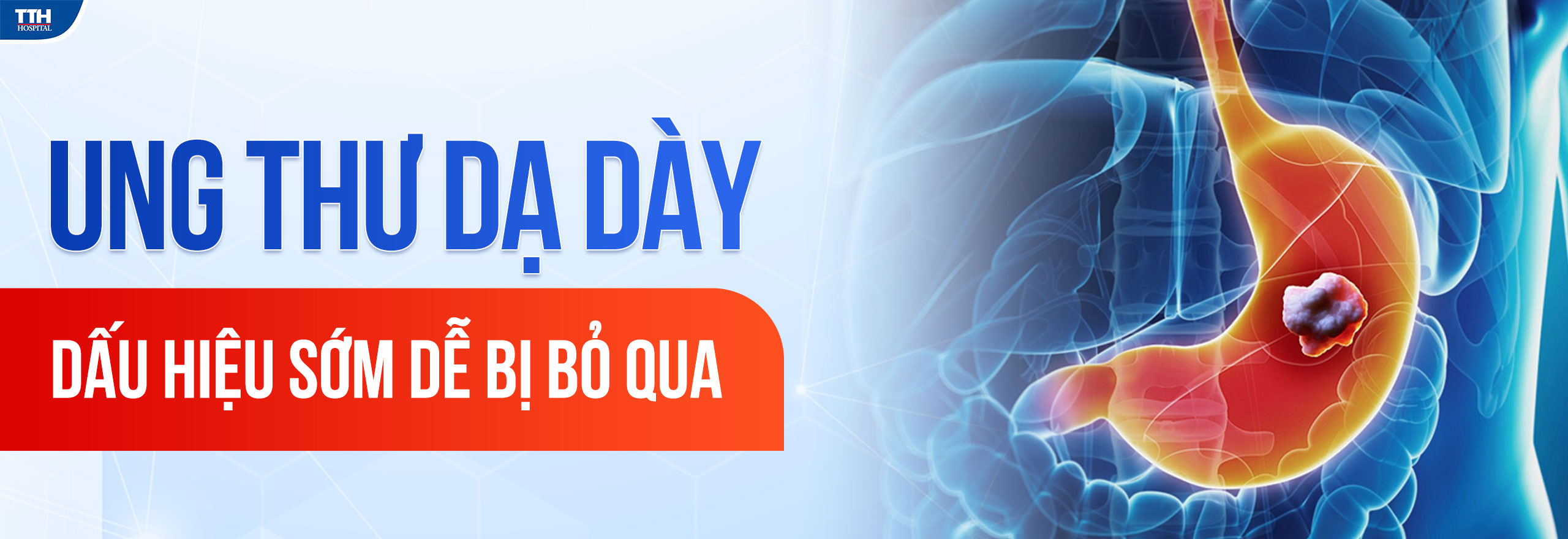 UNG THƯ DẠ DÀY: DẤU HIỆU SỚM DỄ BỊ BỎ QUA
